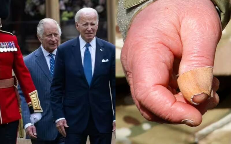 El problema de los "dedos de salchicha" del rey Carlos III han sido un problema desde siempre.