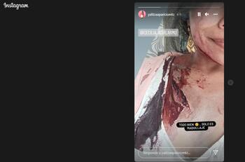 Yalitza Aparicio preocupa a sus seguidores tras mostrar una grave herida en su hombro