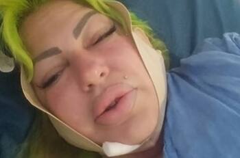 La Diosa de Cuba reaparece tras cirugía estética profunda pero aún con problemas de movilidad