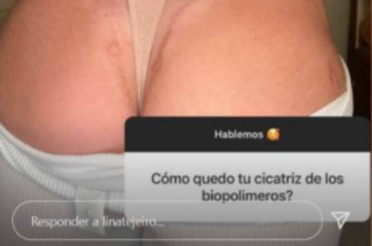 Lina Tejeiro mostró la cicatriz que le quedó al removerse los biopolímeros de sus glúteos