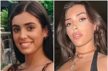 Los dolorosos procesos que la esposa de Kanye West se hizo para parecerse a Kim Kardashian