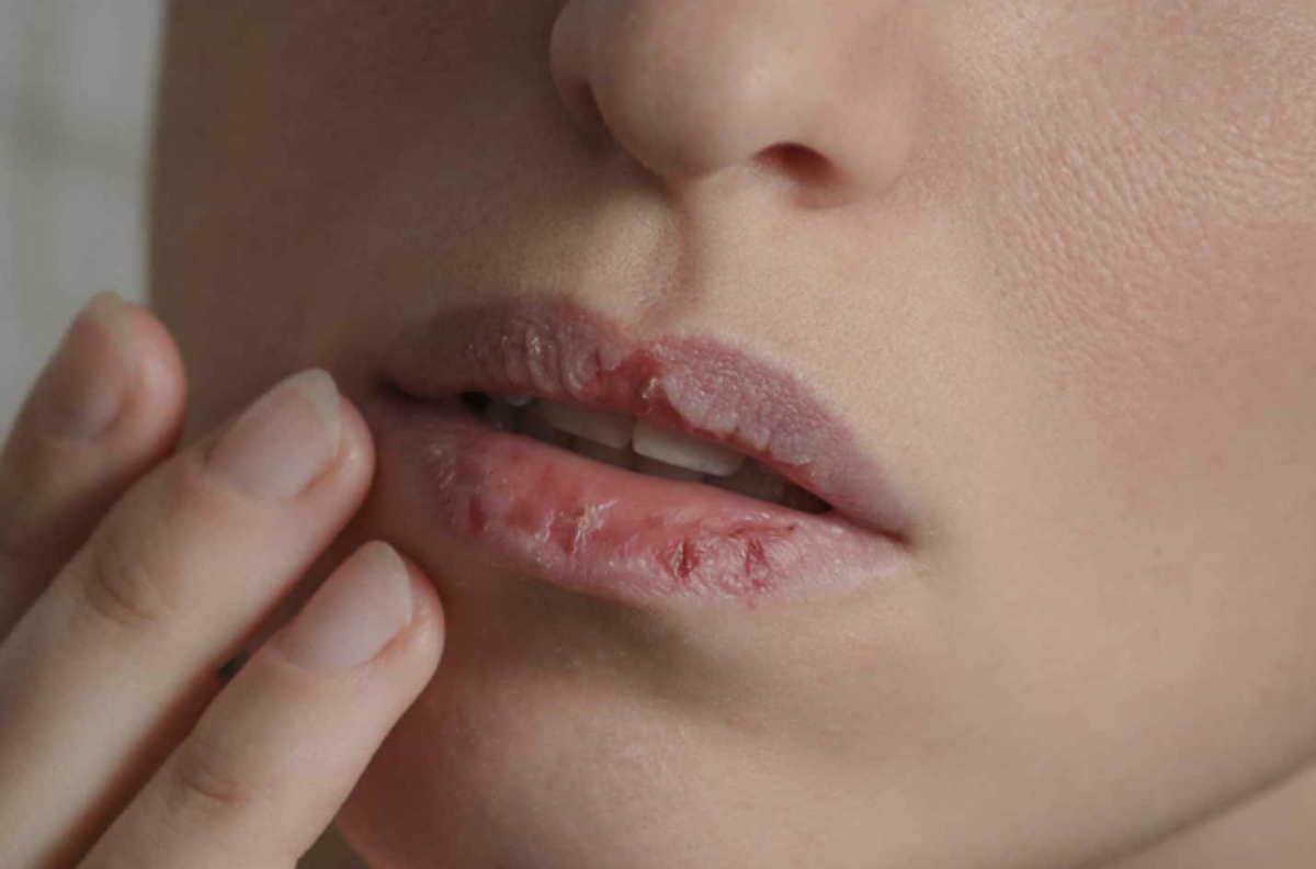 ¿Cómo evitar los labios partidos en esta época de frío?