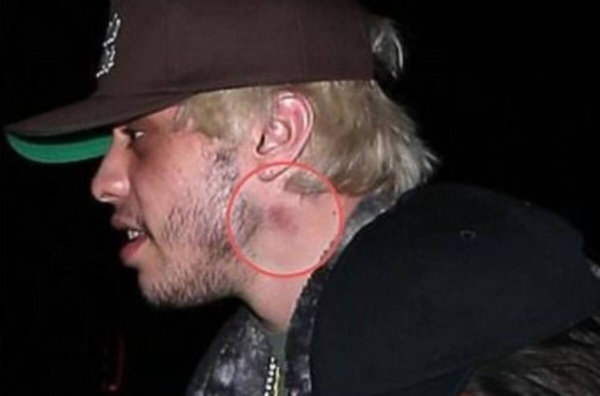 Novio de Kim Kardashian muestra sospechosa marca en el cuello, ¿qué le pasó?