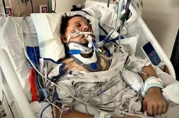 Jeremy Renner contó que el accidente lo dejó con uno ojo colgando de su rostro