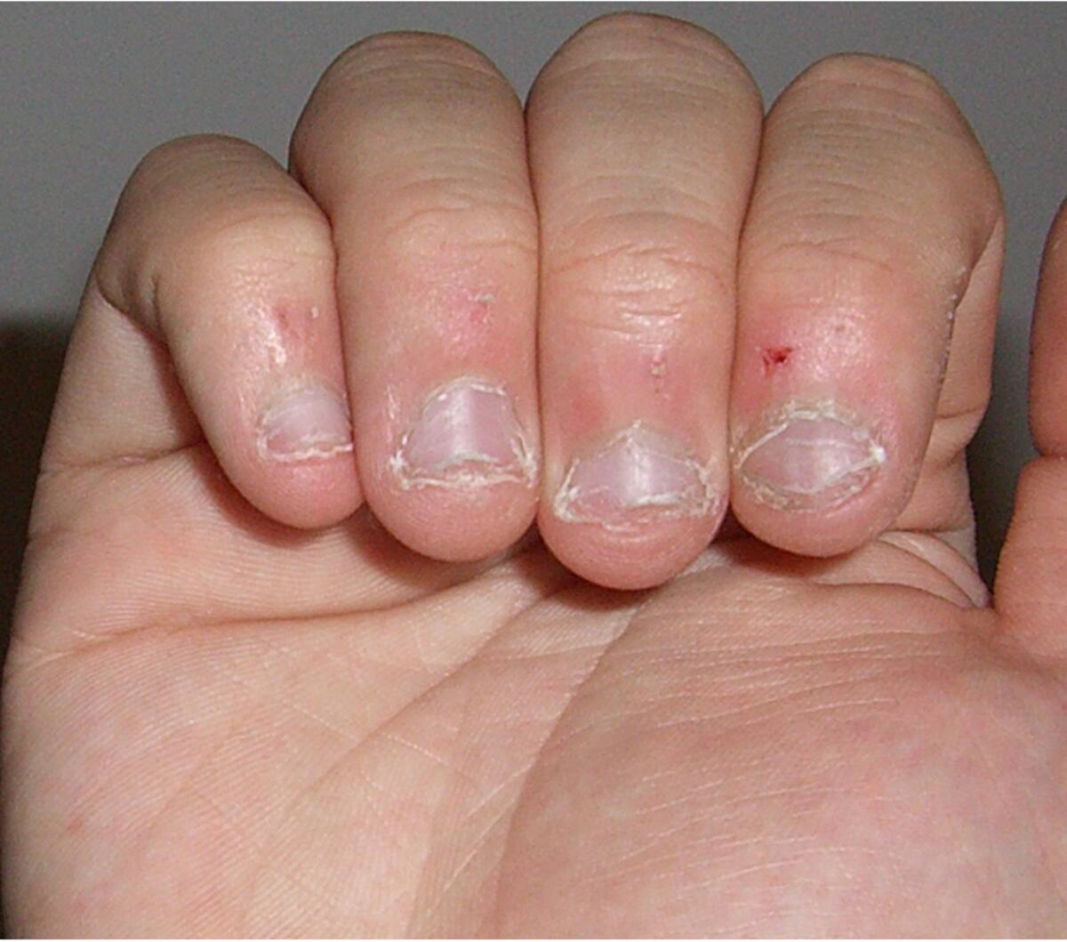 Morderse las uñas trae múltiples daños a la salud